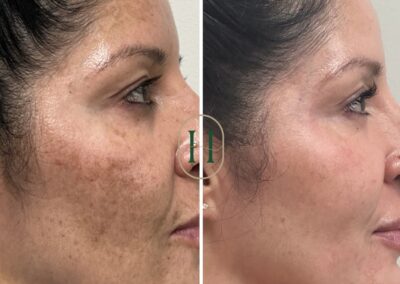 Before and after photos showcasing dramatic results from Ultra Laser Melasma treatment, paired with a custom medical-grade skincare regimen and consistent facials.