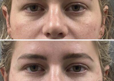 Results of combined treatments including dermal filler, PRF undereye, midface filler, and undereye rejuvenation at Hue Aesthetics in Louisville.