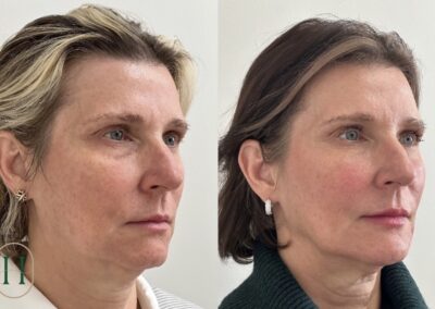 Enhanced facial harmony and natural-looking lips achieved with full facial balancing and lip filler at Hue Aesthetics in Louisville.