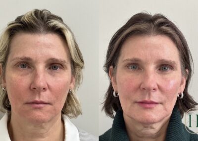 Full facial balancing and lip filler treatments at Hue Aesthetics in Louisville, showcasing enhanced symmetry and volume.