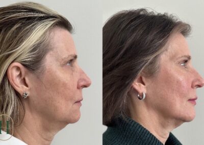 Full facial balancing and lip filler treatments at Hue Aesthetics in Louisville, highlighting improved symmetry and volume.