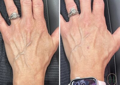 Hand rejuvenation using Hyperdilute Radiesse at Hue Aesthetics in Louisville, KY, showing smoother, more youthful-looking hands