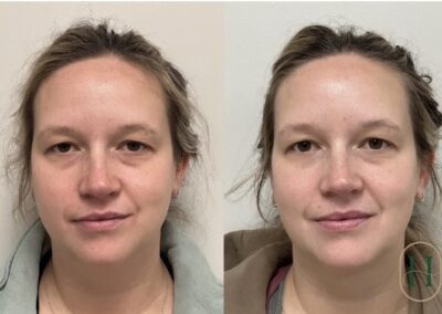 Before and after transformation showcasing PRF undereye rejuvenation, Botox, and neurotoxin treatments at Hue Aesthetics in Louisville.