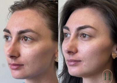 PRP undereye rejuvenation treatment at Hue Aesthetics in Louisville, KY, showing brighter and more youthful eyes.