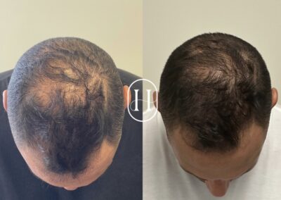 Before and after results of PRP hair restoration treatment combined with Nutrafol at Hue Aesthetics, showing thicker, fuller hair growth