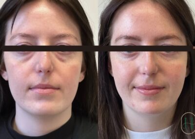 PRP undereye rejuvenation combined with midface dermal filler at Hue Aesthetics in Louisville, showing brighter eyes and lifted cheekbones.