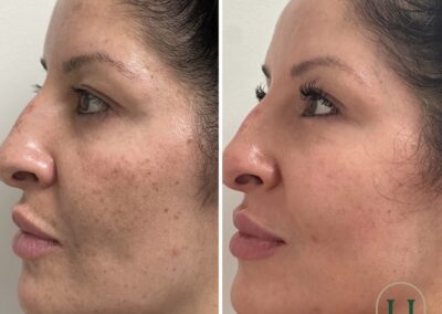 Comparison of skin before and after Ultra Laser Melasma treatment with medical-grade skincare and consistent facials in Louisville