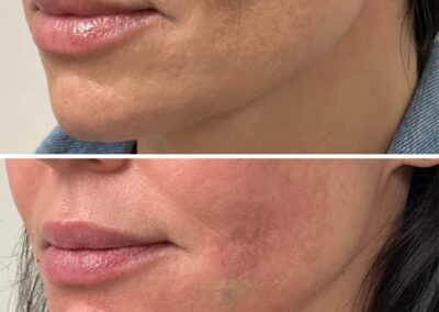 Close-up of natural results achieved with dermal filler treatments at Hue Aesthetics in Louisville