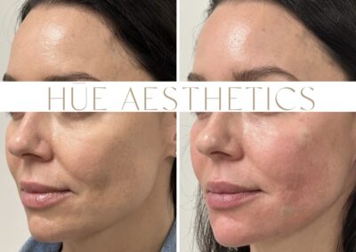 Before and after images of dermal filler treatment highlighting restored volume and smoother skin at Hue Aesthetics in Louisville