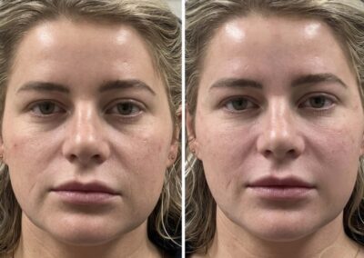 Before and after transformation showing results from dermal filler, PRF undereye, midface filler, and undereye rejuvenation at Hue Aesthetics in Louisville.