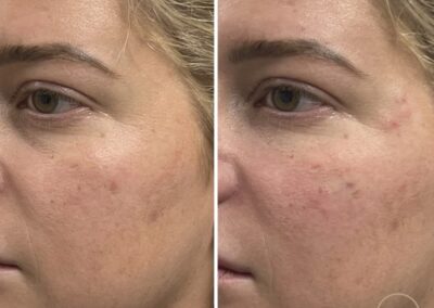 Facial rejuvenation results with dermal filler, PRF undereye, midface filler, and undereye treatments at Hue Aesthetics in Louisville